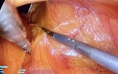 laparoskopická nefrektomie